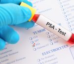 PSA test Blood sample for PSA test, diagnosis for prostate cancer